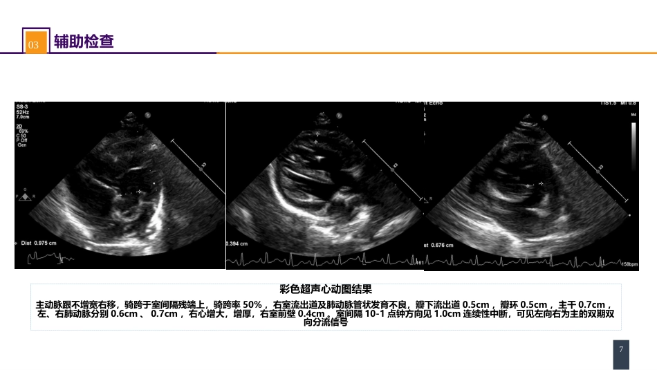 外科学：心脏疾病案例分析-法洛四联症_第7页