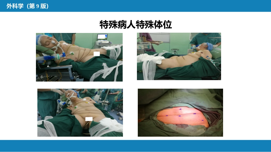 外科学：食管疾病腹腔镜胃底折叠术技术要领_第11页