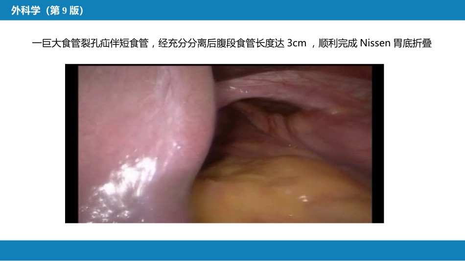 外科学：食管疾病腹腔镜胃底折叠术技术要领_第13页