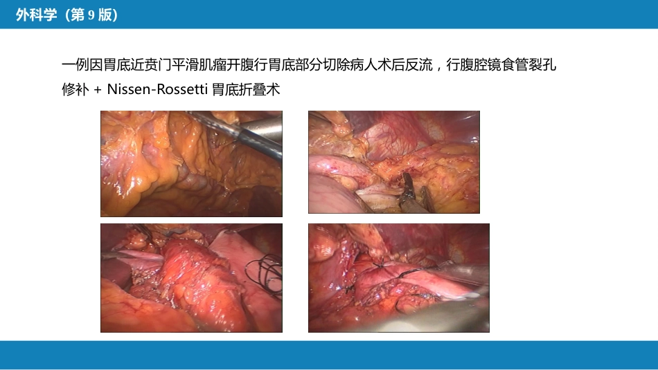 外科学：食管疾病腹腔镜胃底折叠术技术要领_第14页