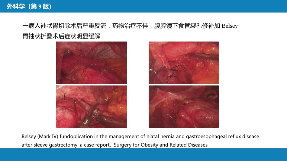 外科学：食管疾病腹腔镜胃底折叠术技术要领_第15页