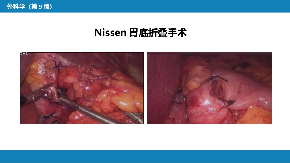 外科学：食管疾病腹腔镜胃底折叠术技术要领_第5页