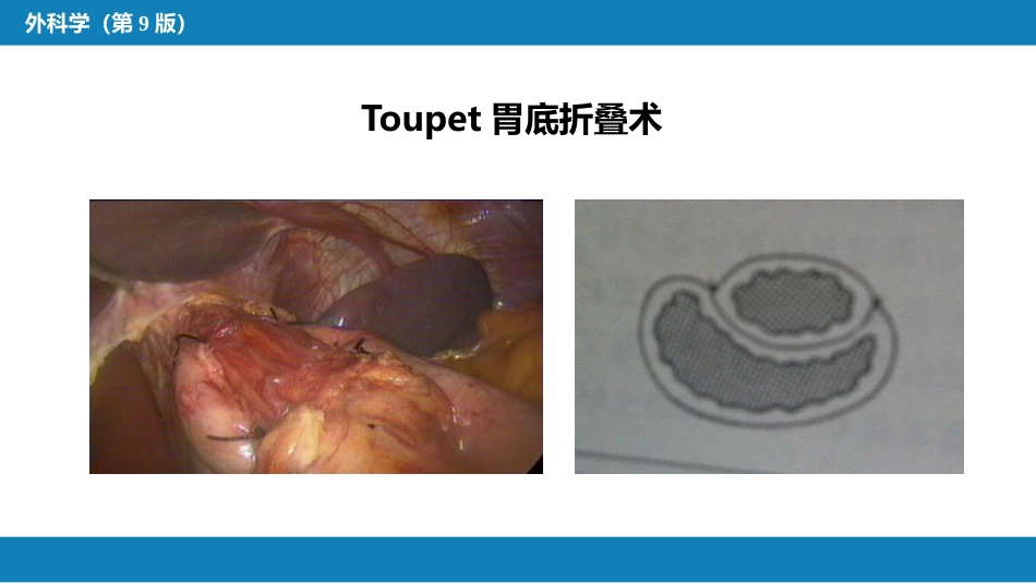 外科学：食管疾病腹腔镜胃底折叠术技术要领_第6页