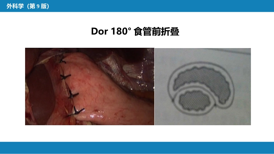 外科学：食管疾病腹腔镜胃底折叠术技术要领_第7页