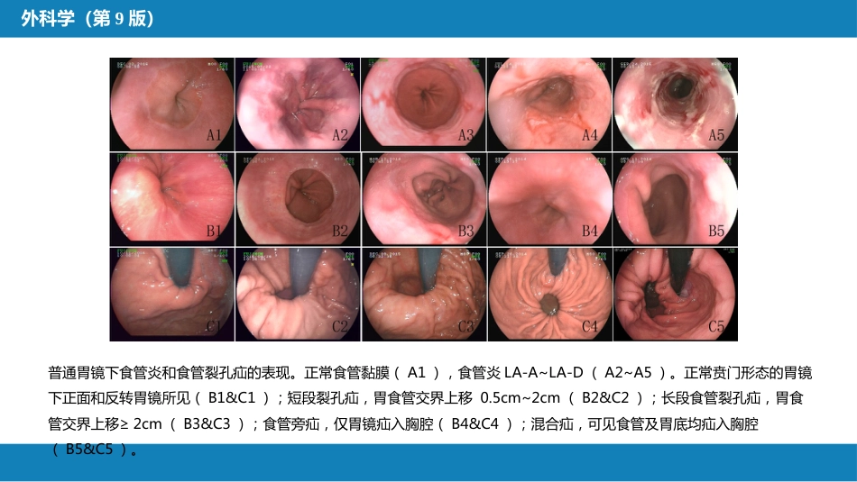 外科学：食管疾病第六节胃食管反流病_第10页