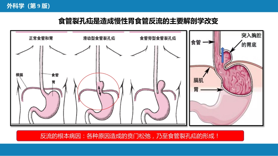 外科学：食管疾病第六节胃食管反流病_第7页