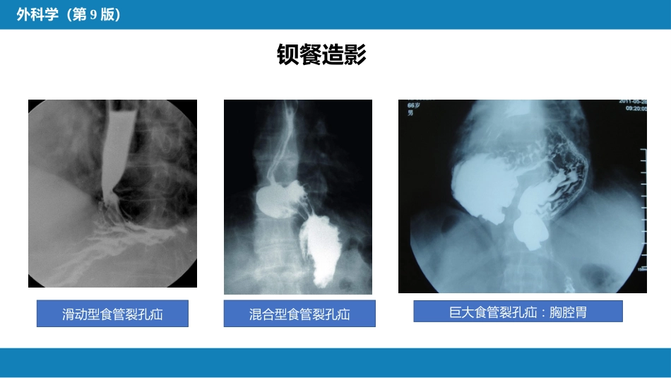 外科学：食管疾病第六节胃食管反流病_第9页