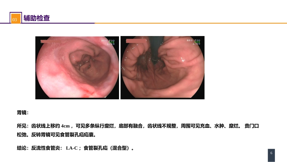 外科学：食管疾病案例分析-胃食管反流病_第6页