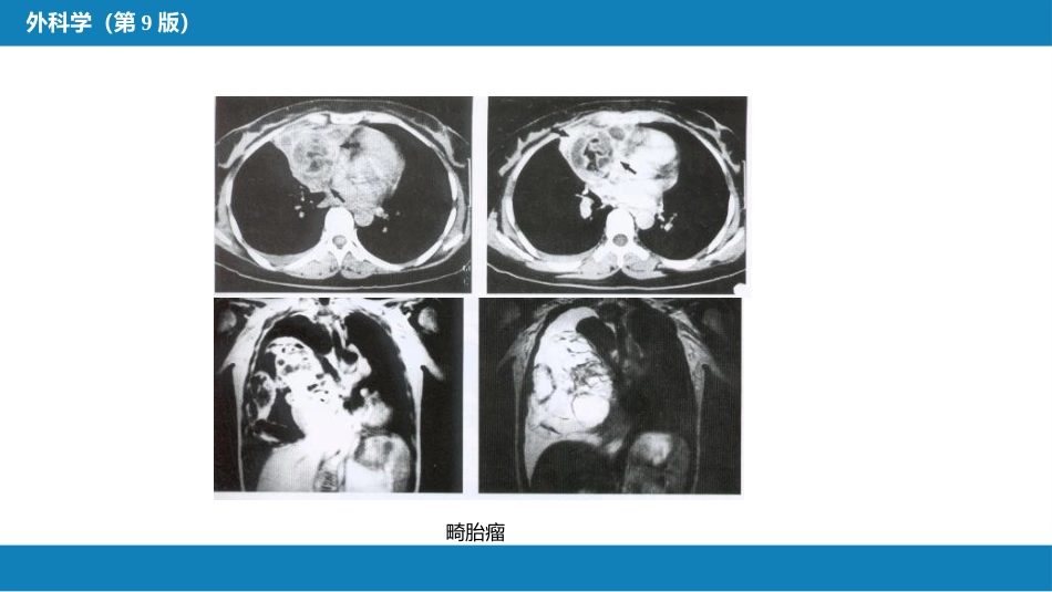 外科学：原发性纵隔肿瘤_第10页