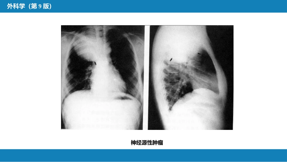 外科学：原发性纵隔肿瘤_第13页