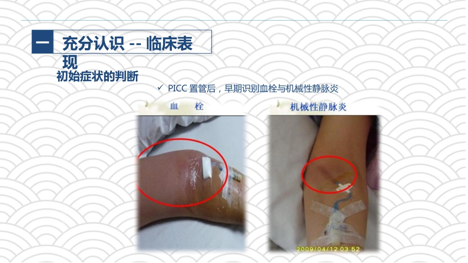 PICC相关静脉血栓护理的业务学习_第9页