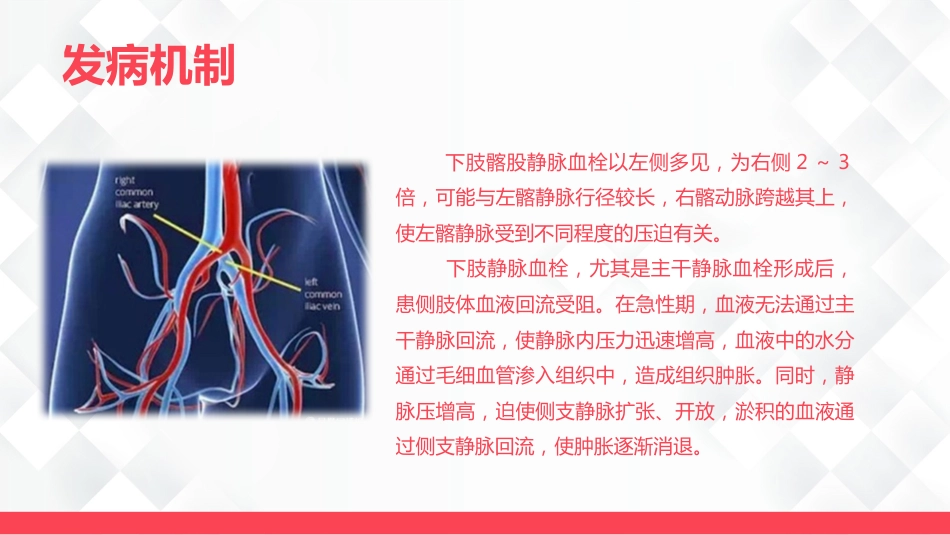 深静脉血栓的护理-业务学习_第10页