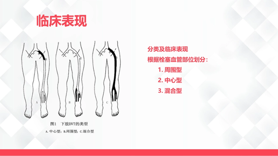 深静脉血栓的护理-业务学习_第11页