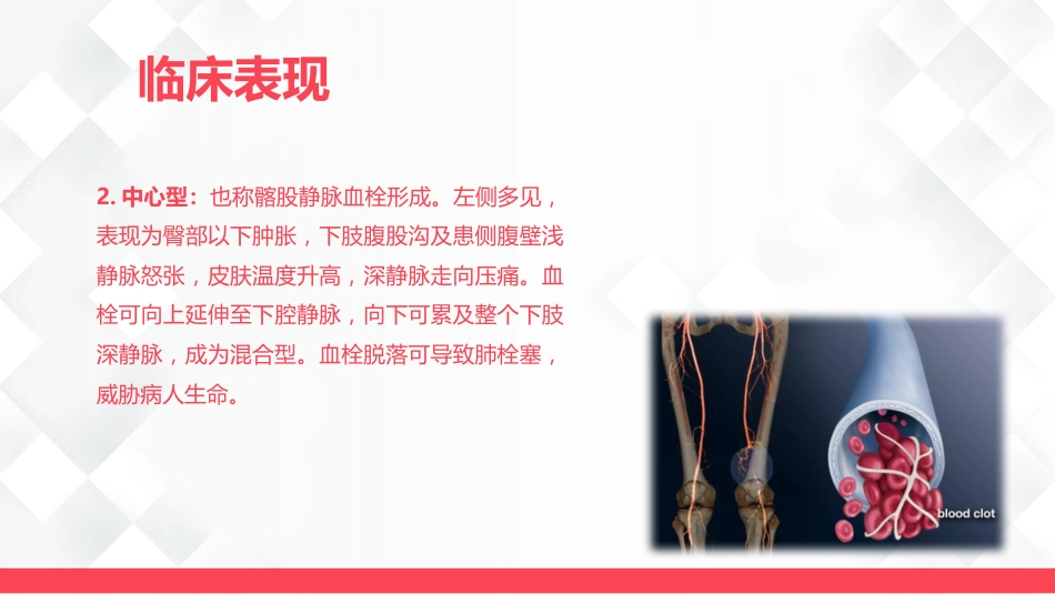深静脉血栓的护理-业务学习_第13页