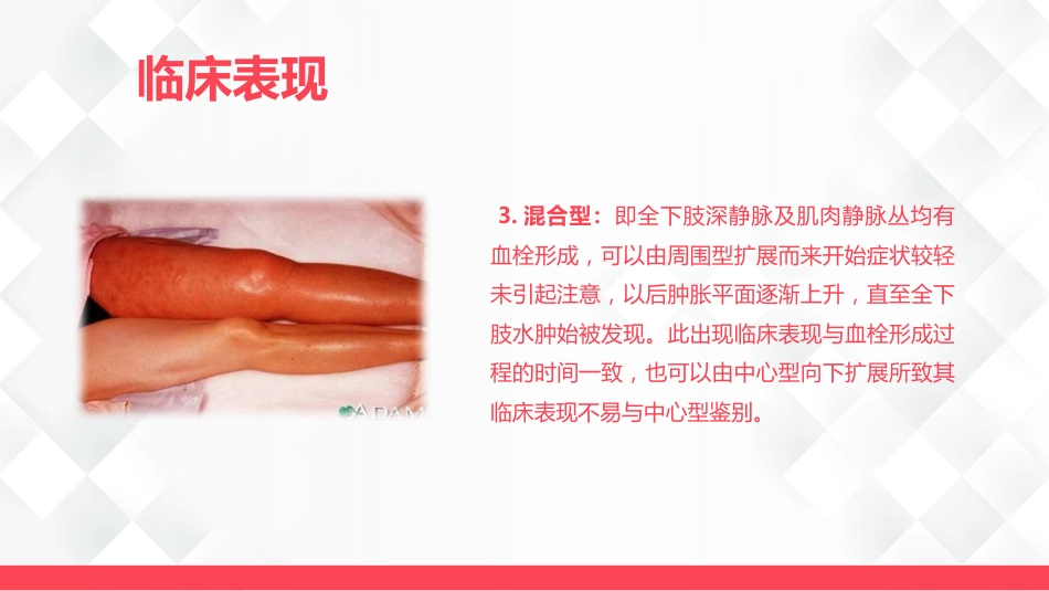 深静脉血栓的护理-业务学习_第14页