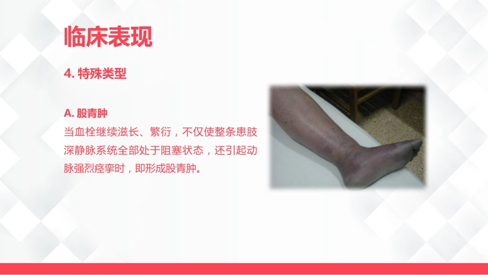 深静脉血栓的护理-业务学习_第15页