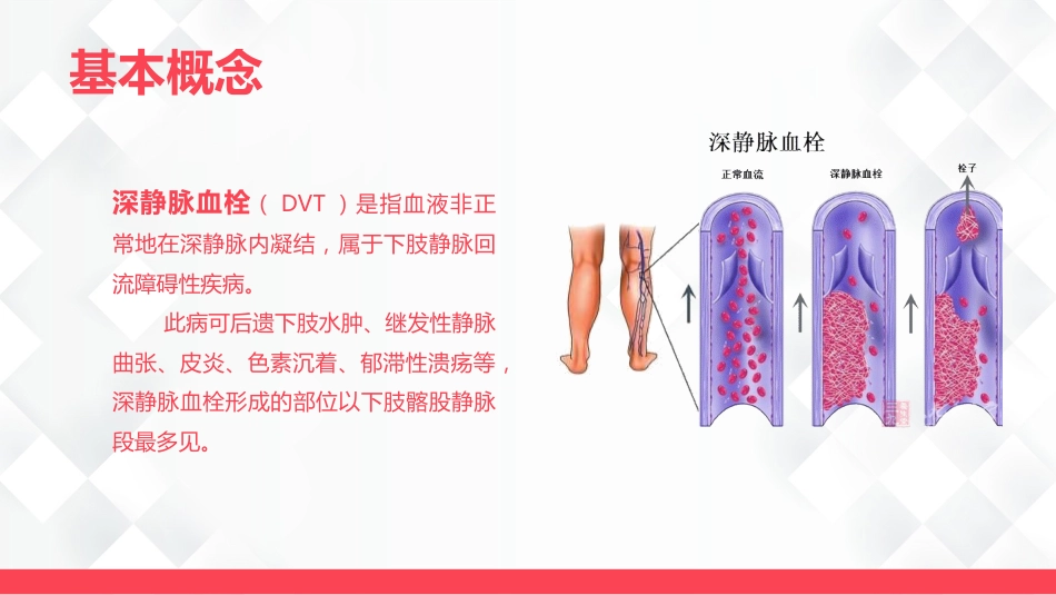 深静脉血栓的护理-业务学习_第4页