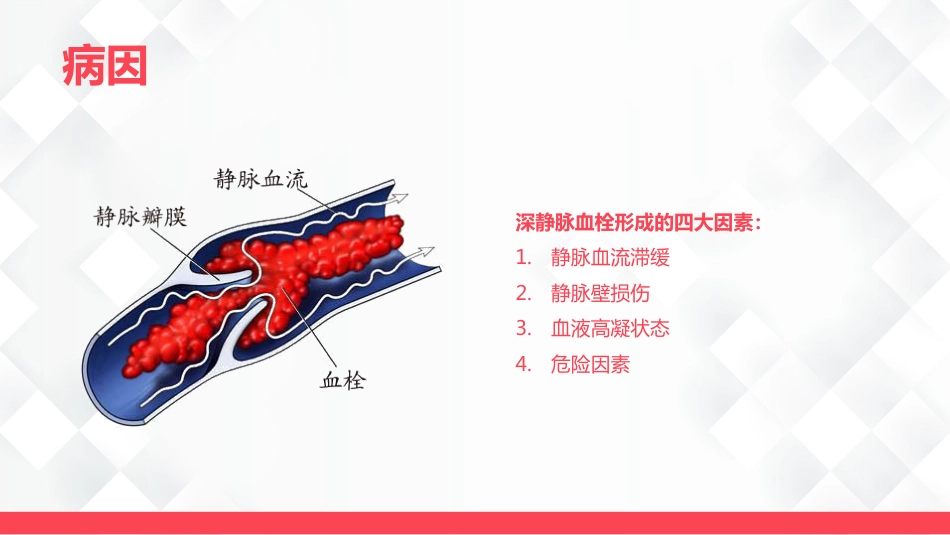 深静脉血栓的护理-业务学习_第5页