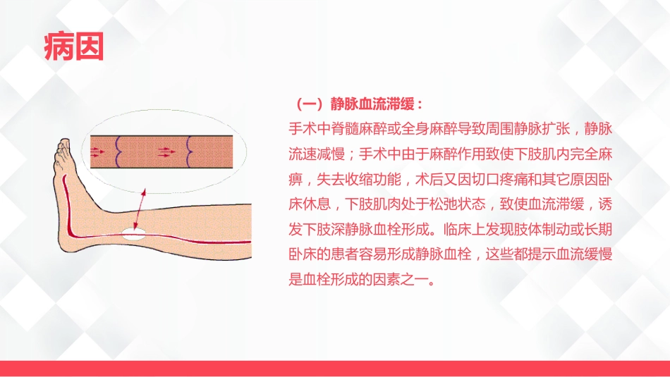 深静脉血栓的护理-业务学习_第6页