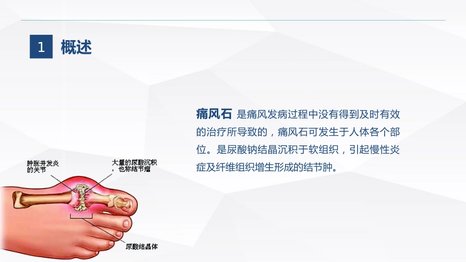 痛风石病人的护理_第4页