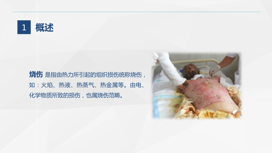 烧伤科-烧伤患者的护理查房_第4页