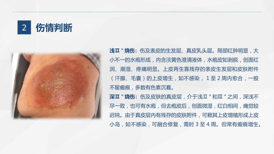 烧伤科-烧伤患者的护理查房_第7页