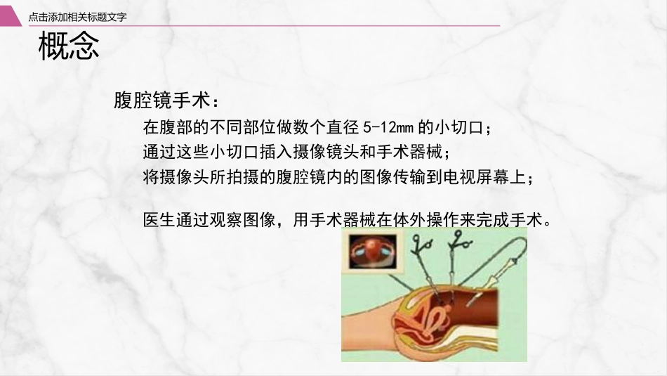 腹腔镜围手术期护理_第4页