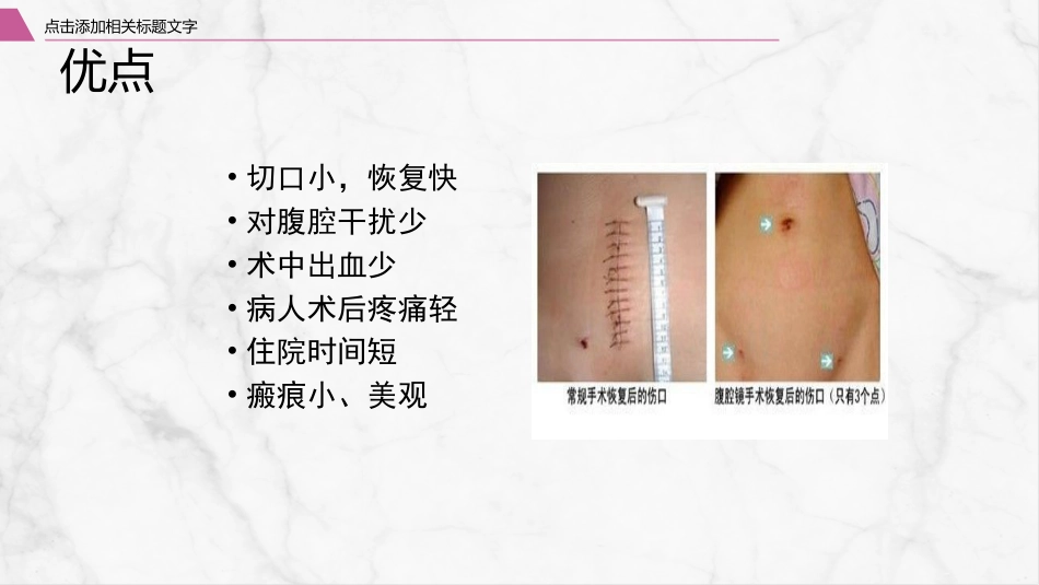 腹腔镜围手术期护理_第8页