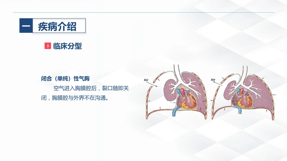 结核病科-结核性胸膜炎患者自发性气胸的护理查房_第7页