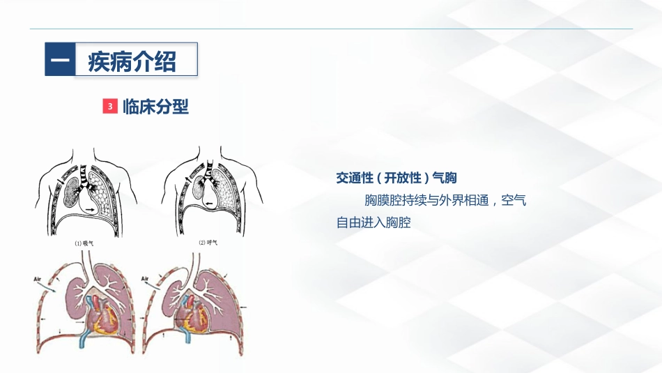 结核病科-结核性胸膜炎患者自发性气胸的护理查房_第8页