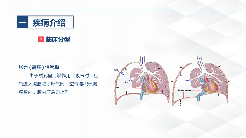 结核病科-结核性胸膜炎患者自发性气胸的护理查房_第9页