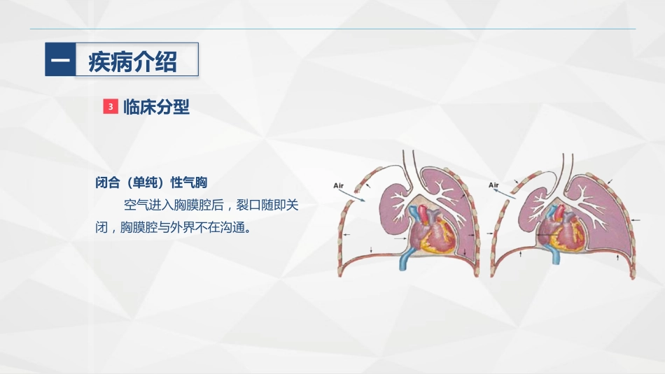 胸科-胸膜炎患者自发性气胸的护理查房_第7页