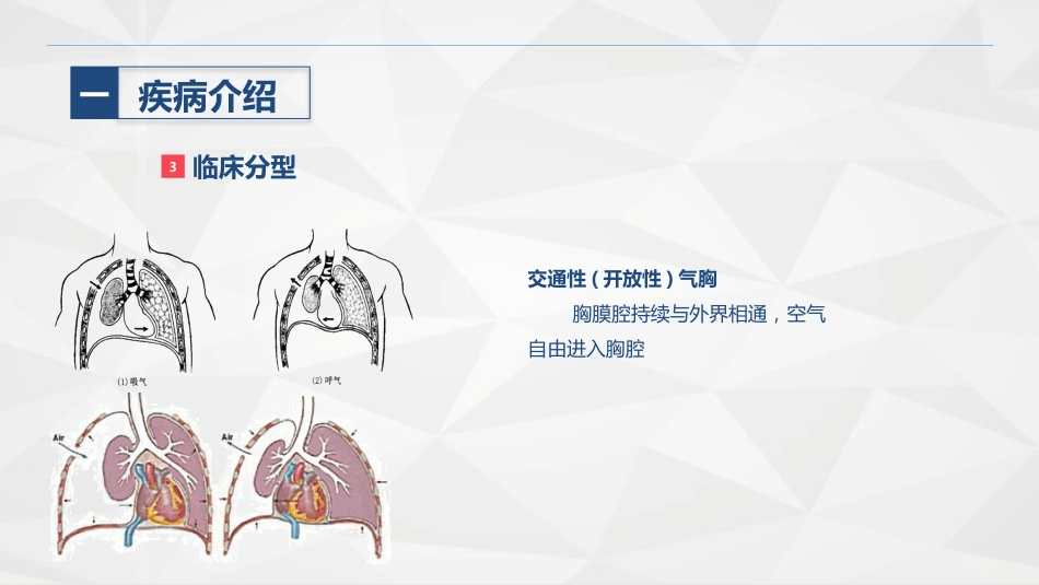 胸科-胸膜炎患者自发性气胸的护理查房_第8页