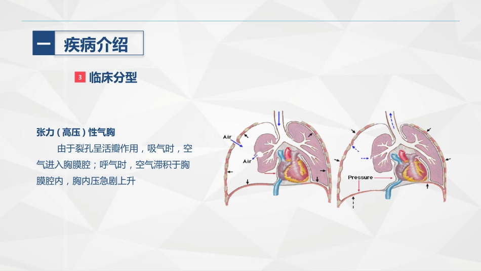 胸科-胸膜炎患者自发性气胸的护理查房_第9页