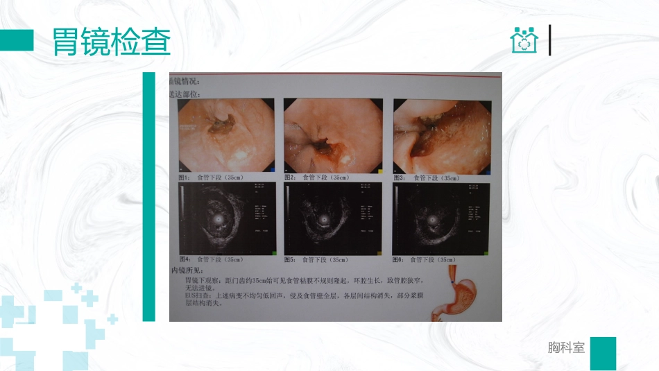 胸外科病例汇报_第11页