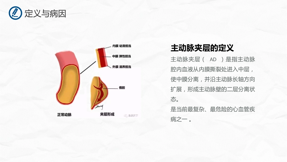 主动脉夹层护理_第4页