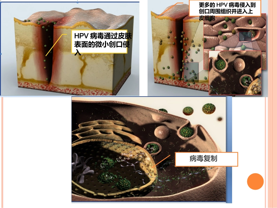 《认识HPV病毒感染》_第7页