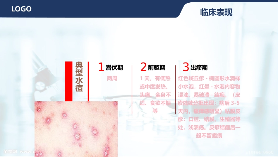 水痘护理查房_第15页