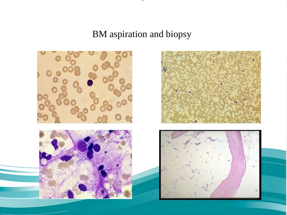 Aplastic anemia再生障碍性贫血-英文_第10页