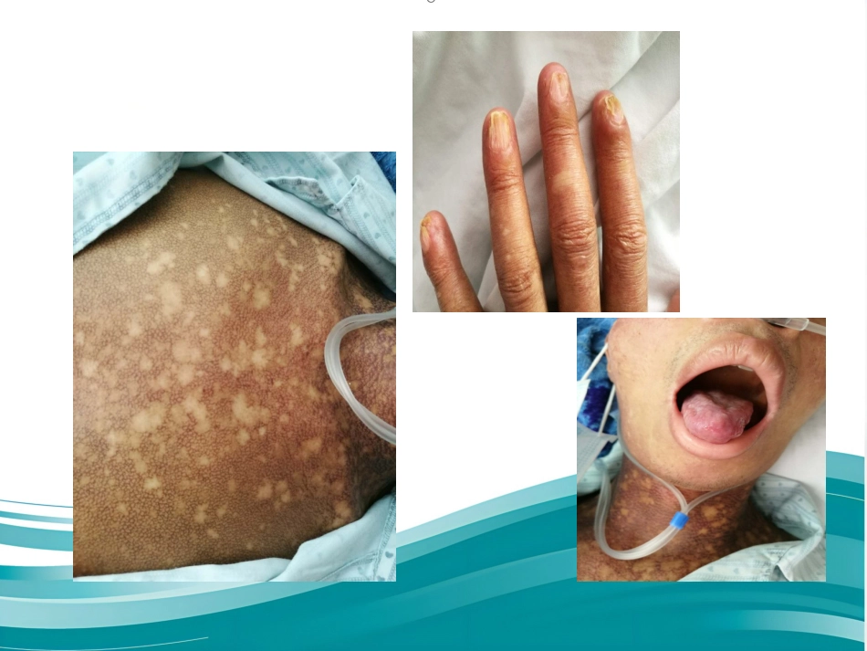 Aplastic anemia再生障碍性贫血-英文_第5页