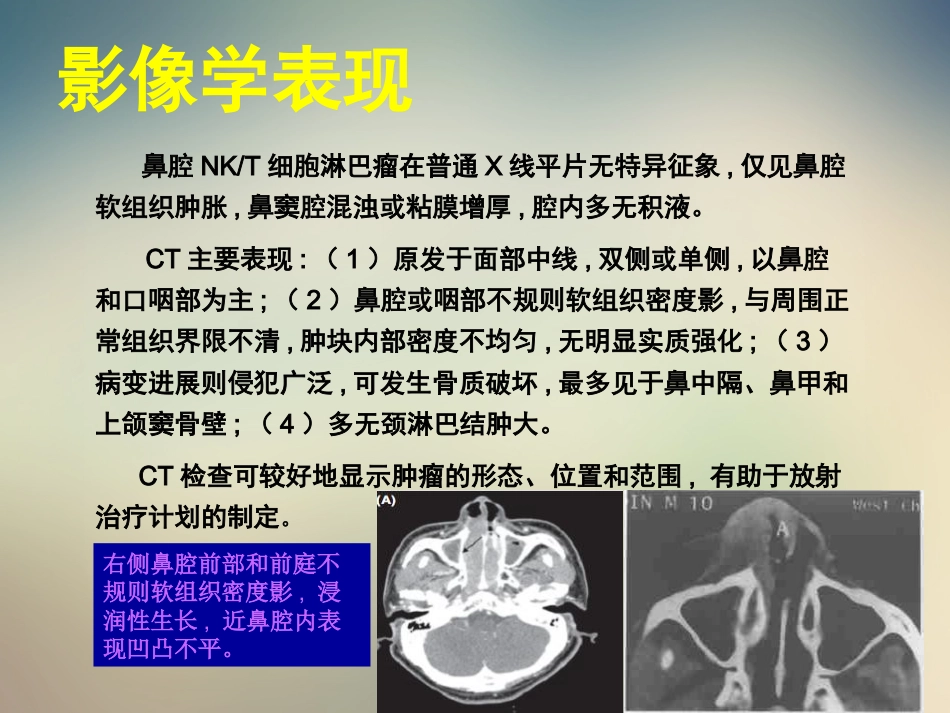 2020—8-21结外NKT细胞淋巴瘤治疗进展_第13页