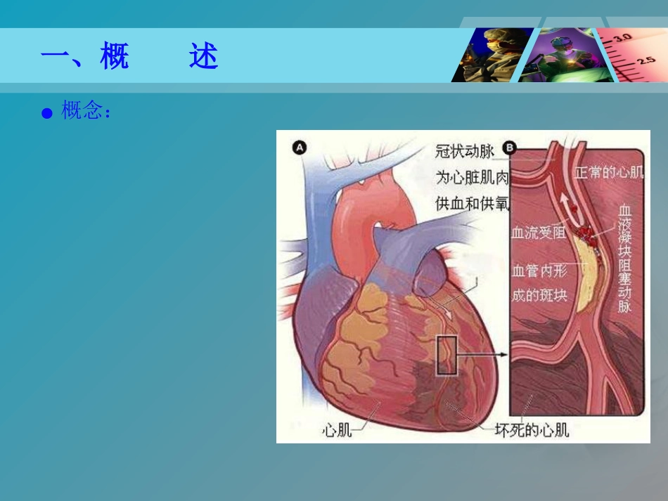 《全国“创新杯”医药卫生类类说课大赛课件特等奖作品：心肌梗死课件_第4页