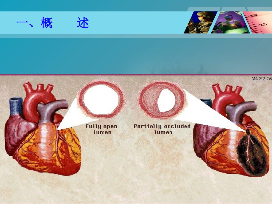 《全国“创新杯”医药卫生类类说课大赛课件特等奖作品：心肌梗死课件_第6页