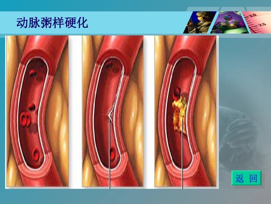 《全国“创新杯”医药卫生类类说课大赛课件特等奖作品：心肌梗死课件_第7页
