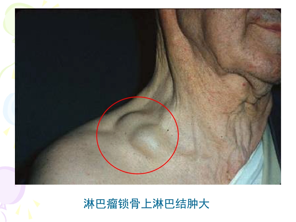 《淋巴瘤》ppt课件_第15页