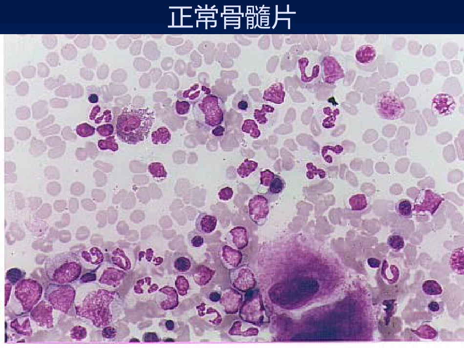 《急性白血病》PPT课件_第13页