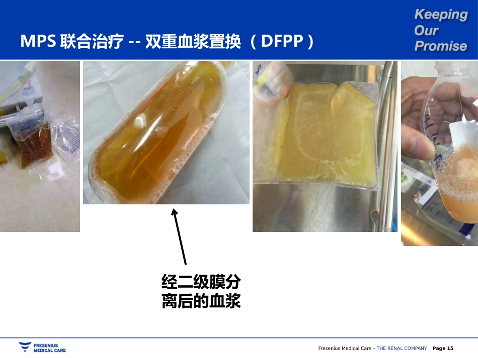 双重血浆置换_第15页