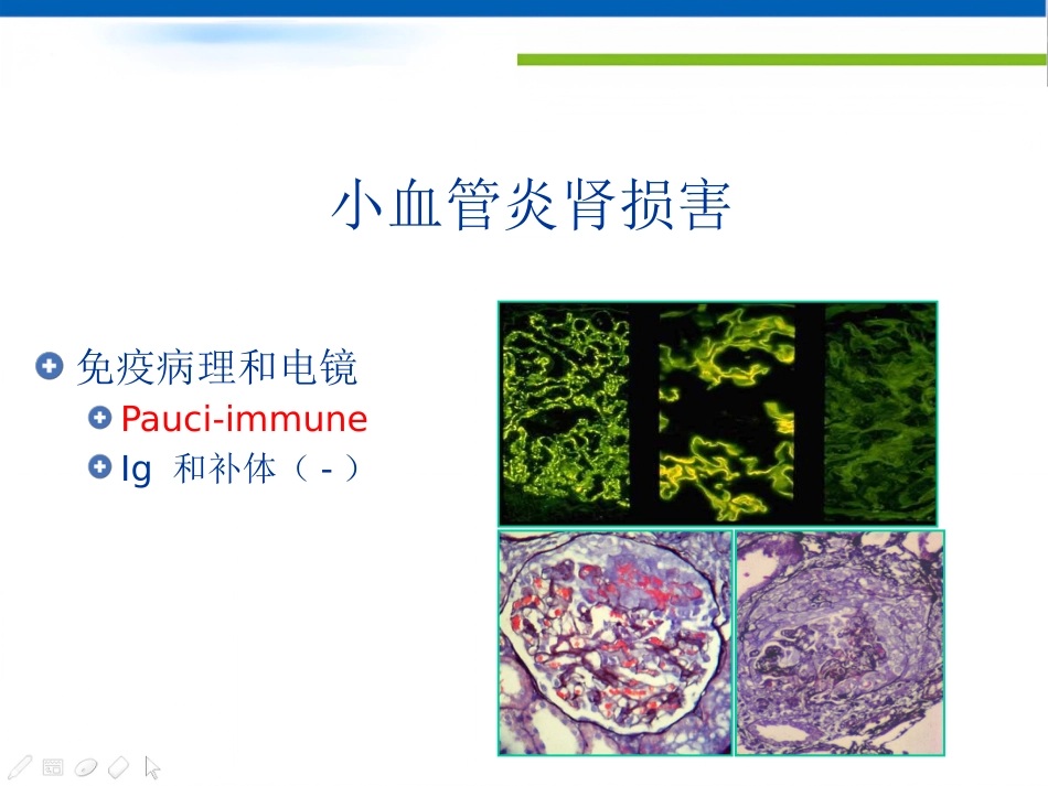 ANCA相关性小血管炎的诊治_第15页
