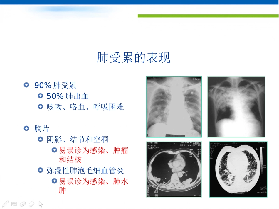ANCA相关性小血管炎的诊治_第4页