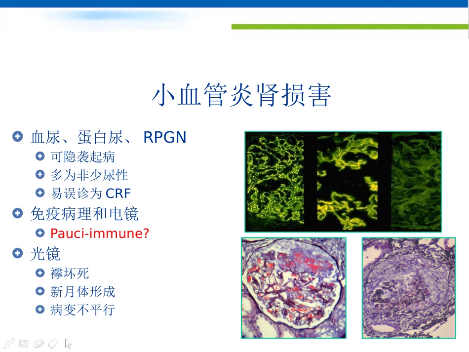 ANCA相关性小血管炎的诊治_第5页
